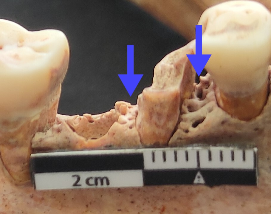 Porositat i pèrdua d’os alveolar (indicat per les fletxes) per periodontitis en un individu de Cal Pa i Figues. Font: Laura Pallarés Viña